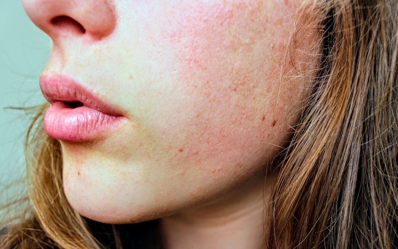 What Does A Vape Rash Look Like?